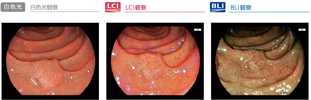 白色光、BLI観察、LCI観察それぞれで撮影した大腸内部の写真